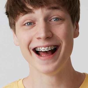 advanced-insignia-braces-cost-dubai