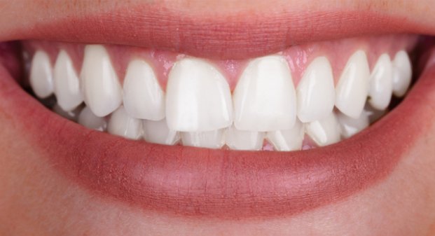 advanced-laser-teeth-whitening-dubai