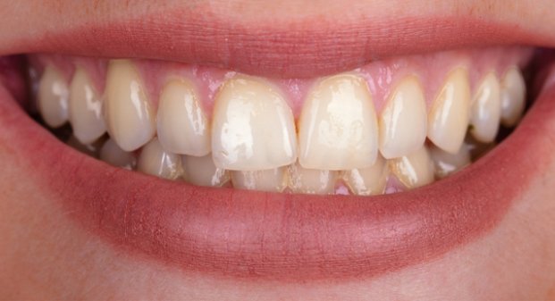 advanced-laser-teeth-whitening-near-me