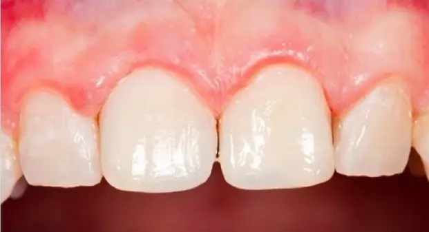 affordable-cavity-filling-for-child-in-dubai