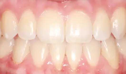 after-results-spark-clear-aligners-dubai