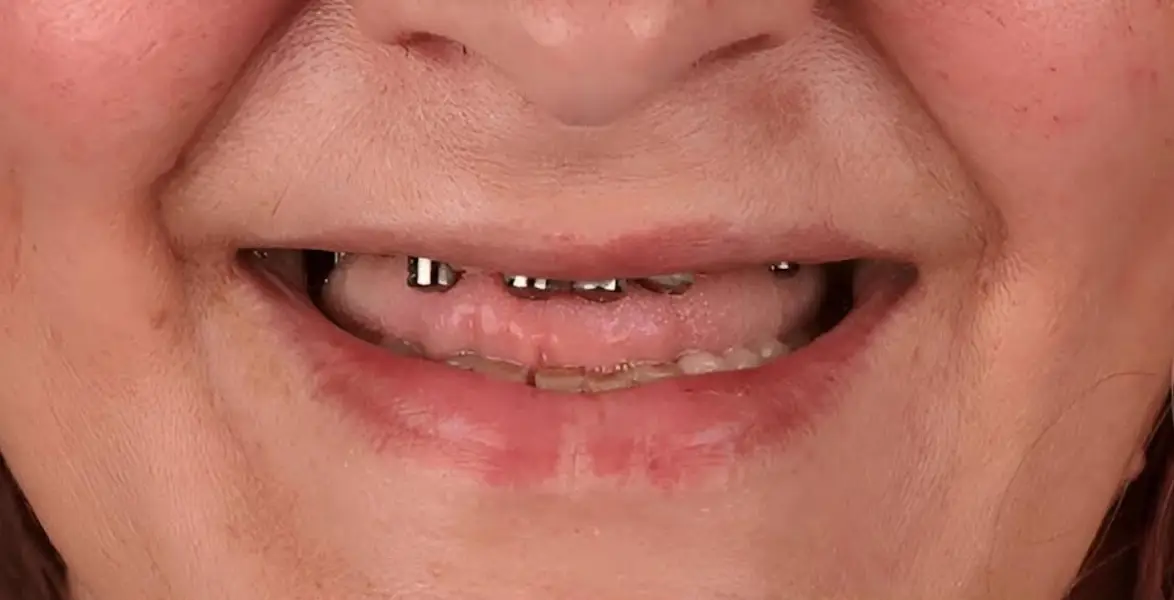 all-on-4-dental-implants-in-dubai