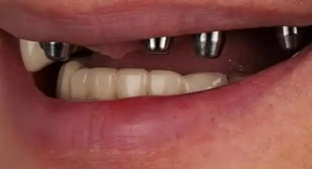 all-on-4-dental-implants-in-UAE