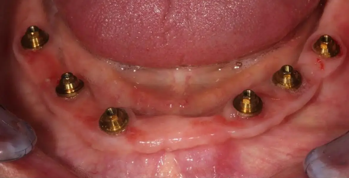 all-on-6-full-mouth-dental-implants-in-dubai