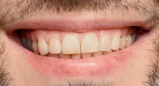 at-home-teeth-whitening-kit-dubai