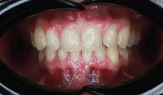 before-and-after-k-line-clear-aligners-dubai