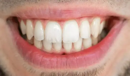 before-and-after-k-line-clear-aligners-UAE