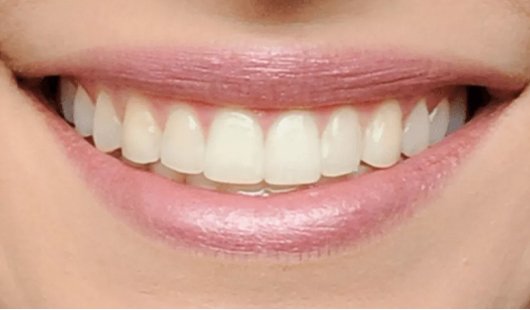 before-and-after-of-metallic-braces-dubai