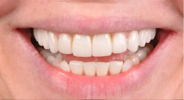 before-and-after-of-veneers-dubai