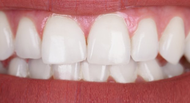 before-and-after-of-zoom-teeth-whitening-dubai