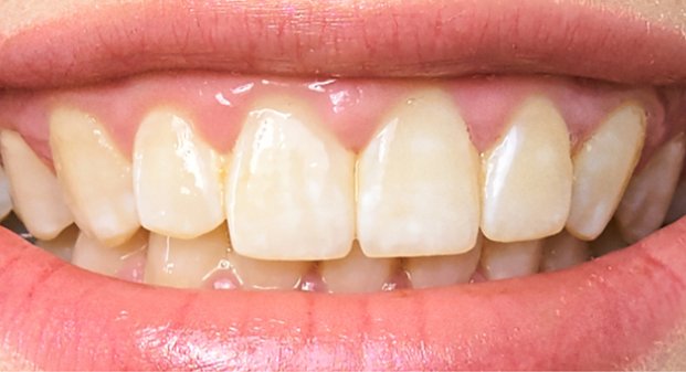 before-and-after-of-zoom-teeth-whitening-UAE