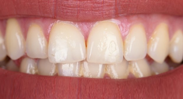 before-and-after-of-zoom-teeth-whitening