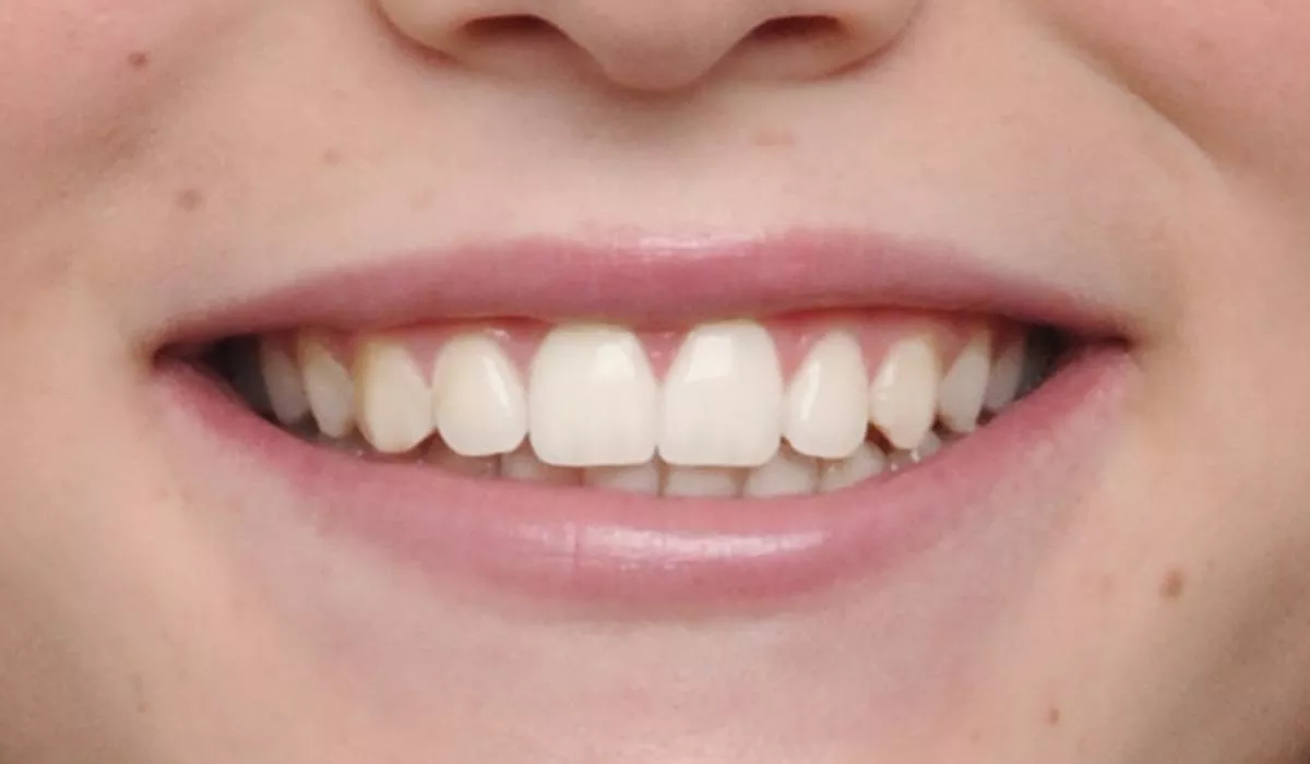 before-and-after-pictures-of-damon-braces-dubai