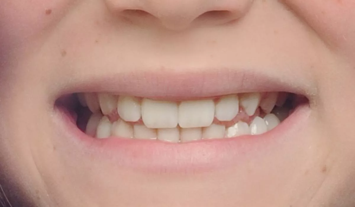 before-and-after-pictures-of-damon-braces-dubai