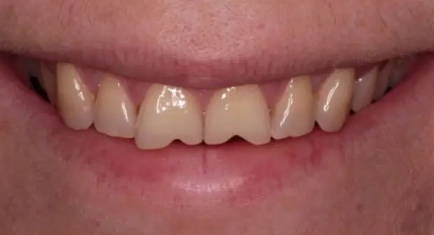 before-and-after-procelain-veneers-in-dubai