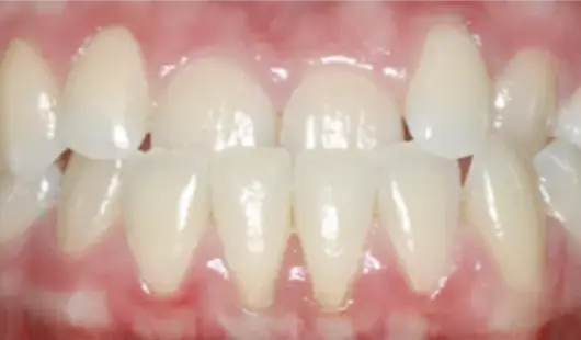 before-results-spark-clear-aligners-dubai