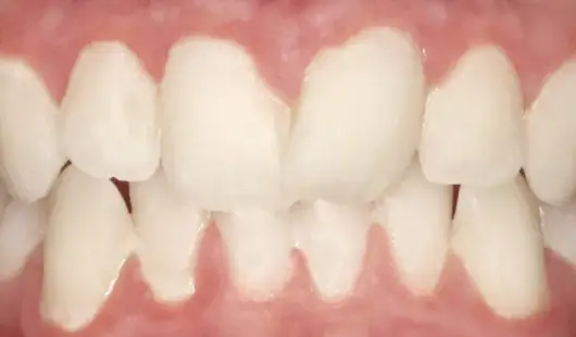 before-results-spark-clear-aligners-UAE