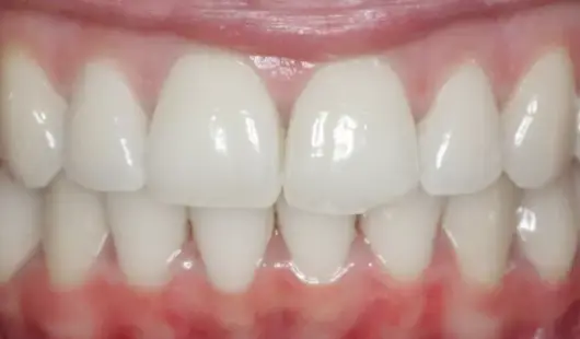 best-after-results-spark-clear-aligners-UAE