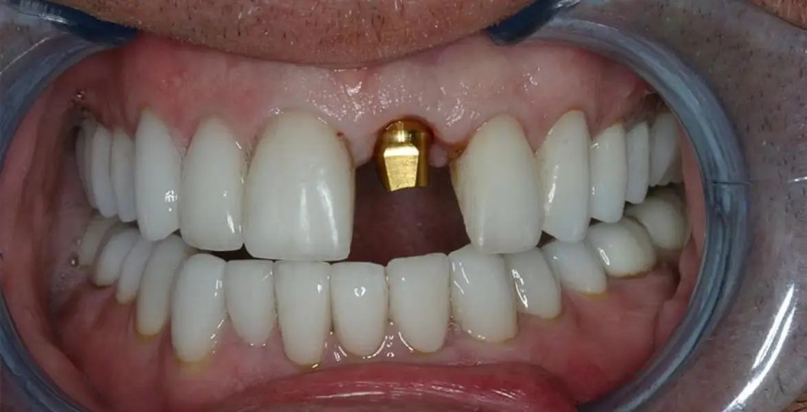 best-dental-implants-dubai