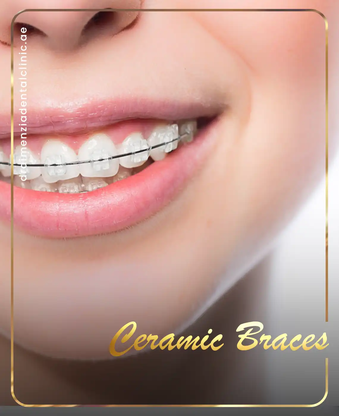 ceramic-braces-consultation-dubai
