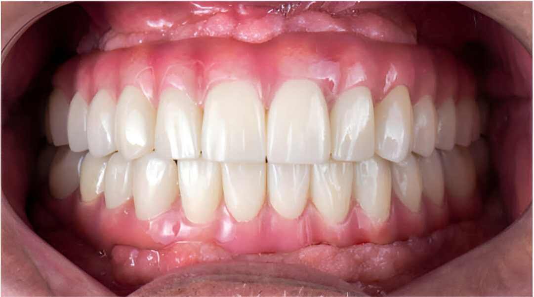 cheap-dental-implants-dubai