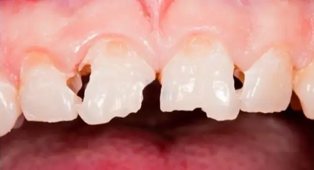 child-pulpectomy-filling-dubai