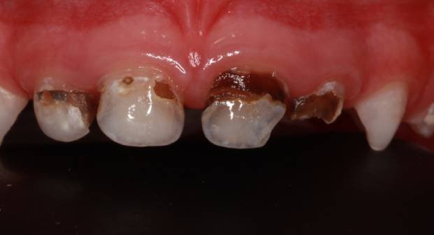 child-pulpectomy-treatment-in-dubai