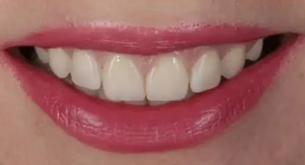 cosmetic-veneers-before-and-after-dubai