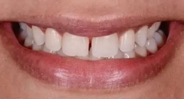 cosmetic-veneers-before-and-after-dubai