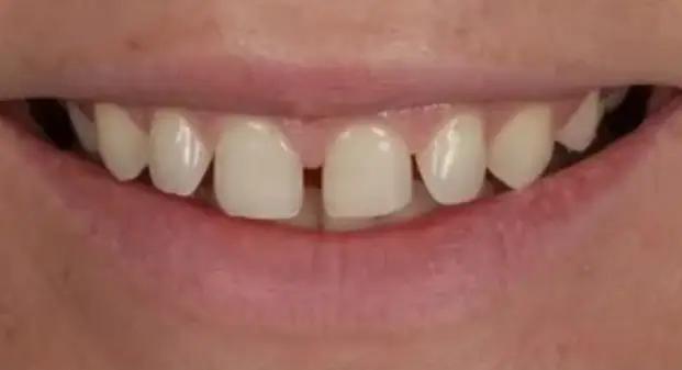 cosmetic-veneers-before-and-after-UAE