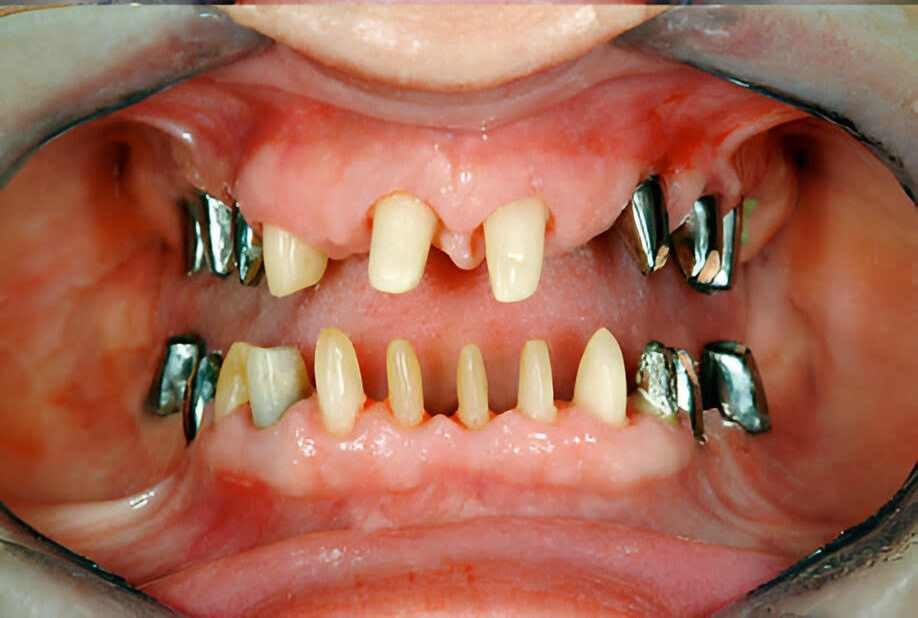 cost-of-dental-implants-dubai