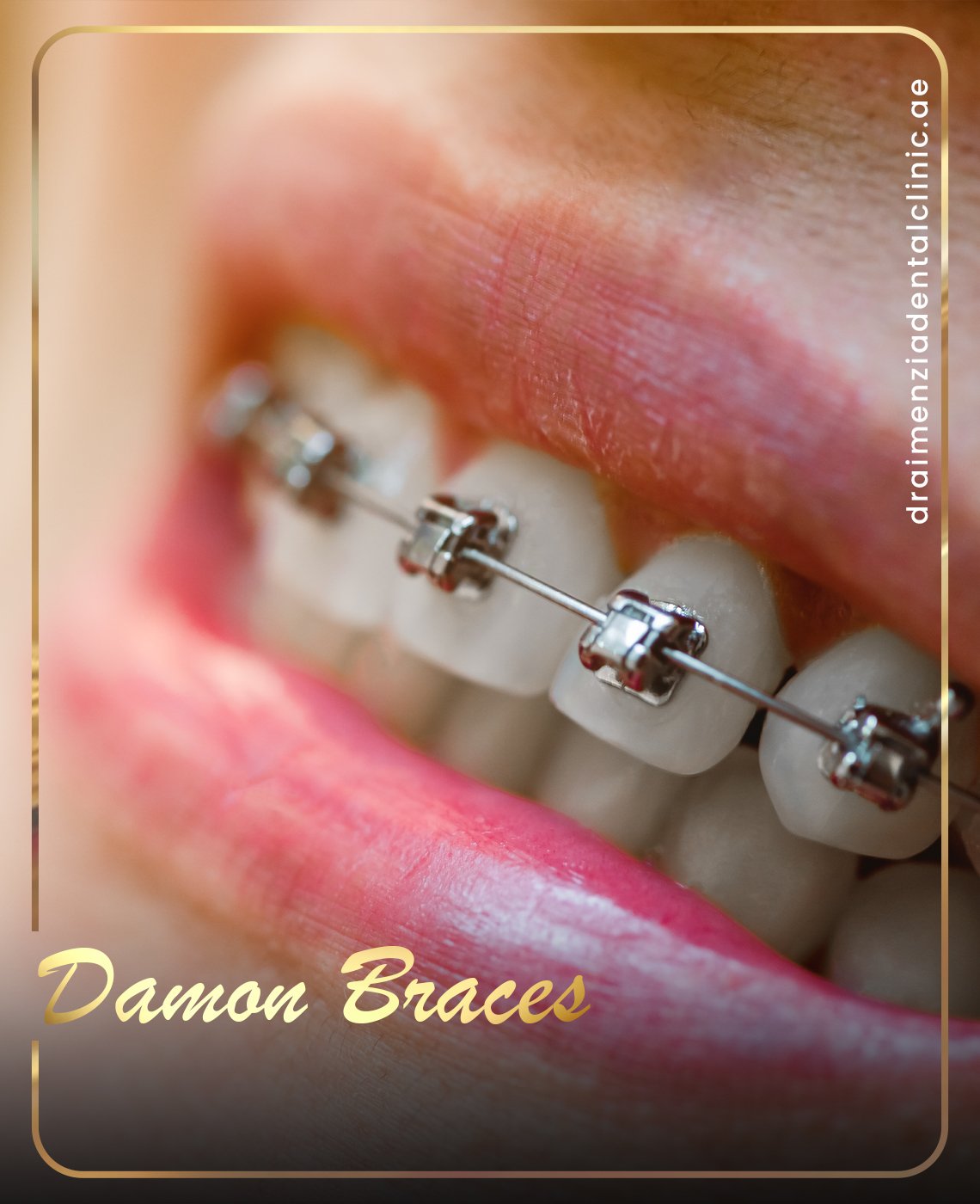 crooked-teeth-treatment-dubai