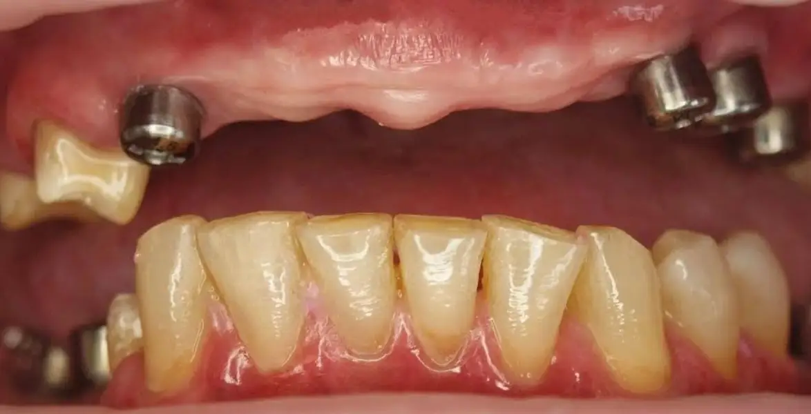 dental-implant-cost-dubai