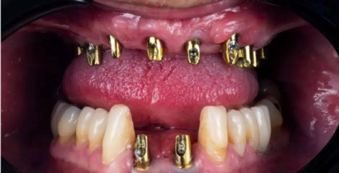 dental-implants-dubai