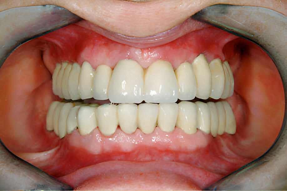 full-mouth-dental-implants-dubai