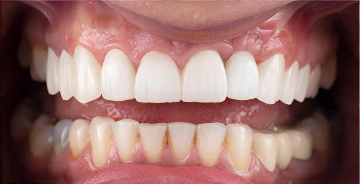 implant-supported-dentures-near-me