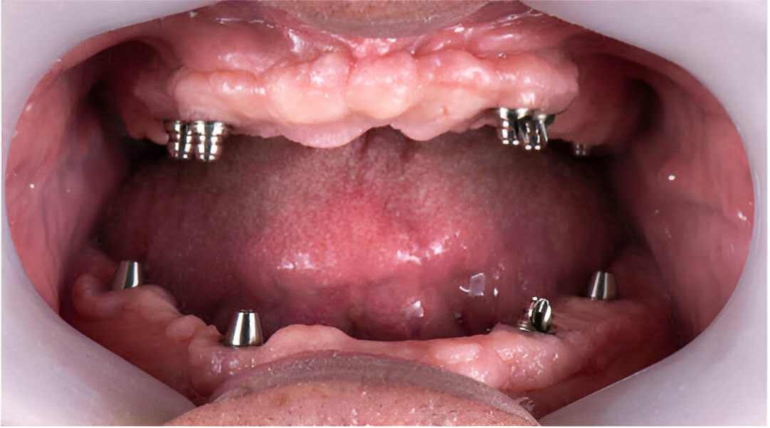 implant-surgeon-near-me