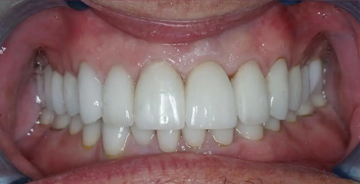 implants-dentist-dubai