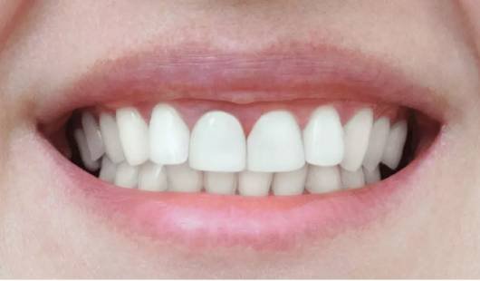 k-line-clear-aligners-before-and-after-dubai