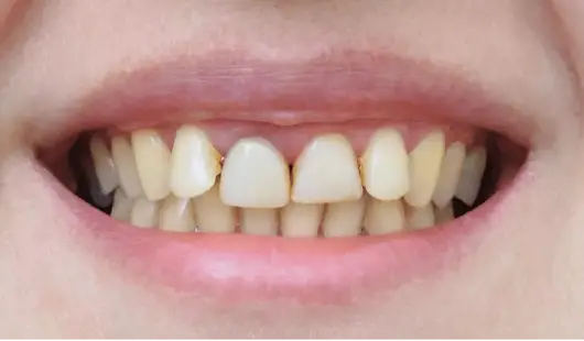 k-line-clear-aligners-before-and-after