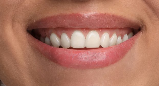 laser-dental-whitening-dubai