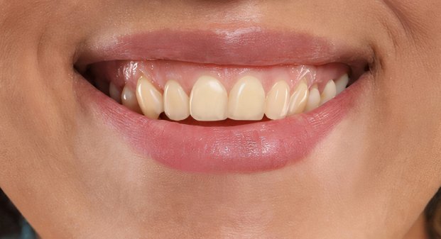 laser-teeth-whitening-clinic-dubai