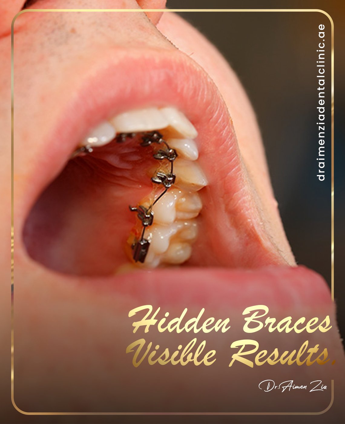 lingual-braces-cost-UAE