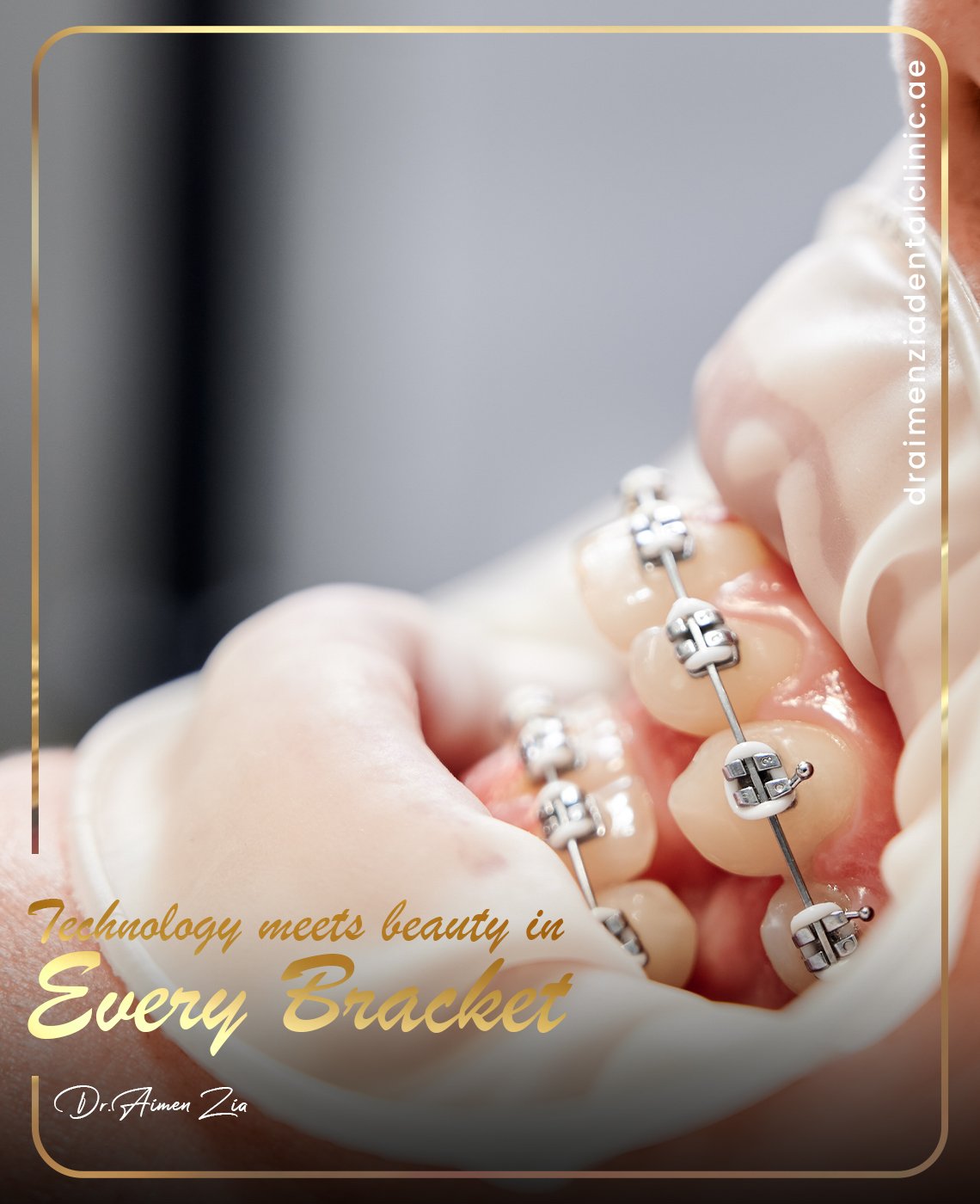 metal-braces-cost-dubai