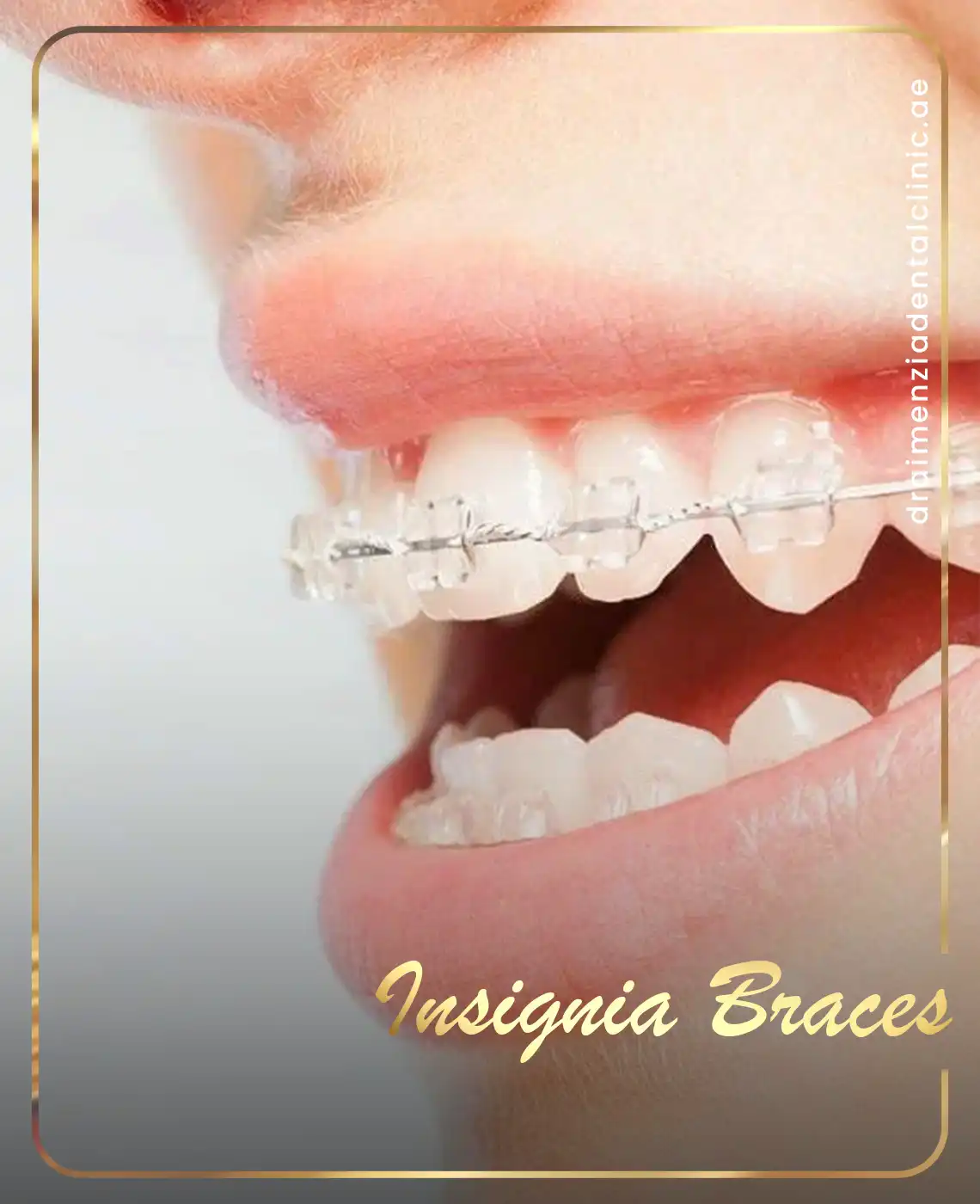 orthodontic-braces-cost-dubai