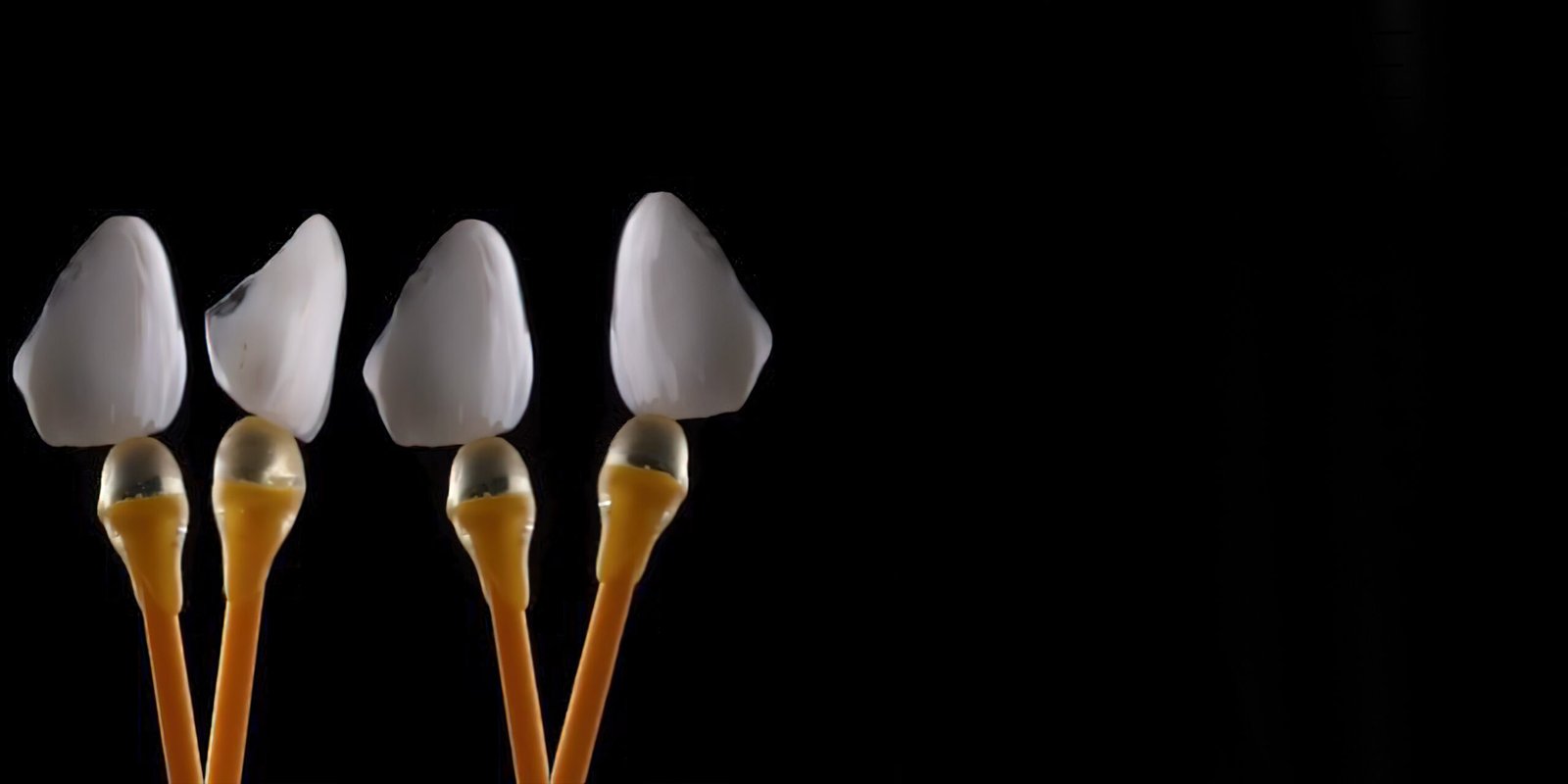 partial-feldspathic-veneers-cost