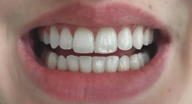 porcelain-veneers-cost-dubai