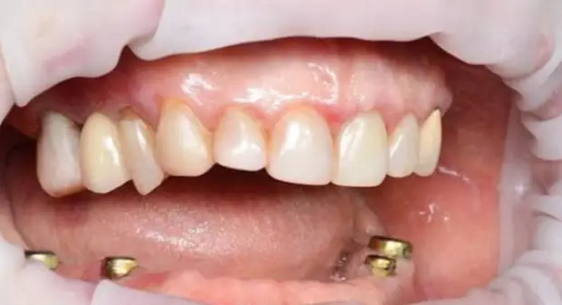 same-day-all-on-4-dental-implants-in-UAE