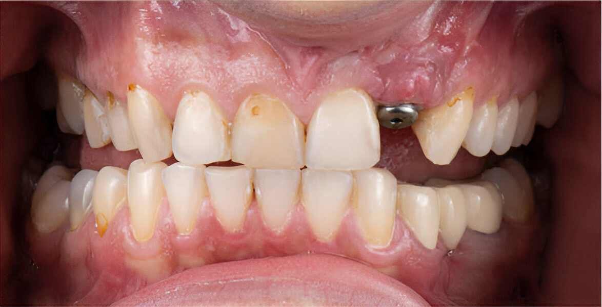 single-tooth-dental-implants-dubai