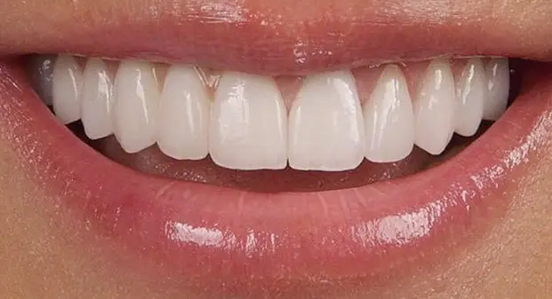 smile-makeover-before-and-after-dubai